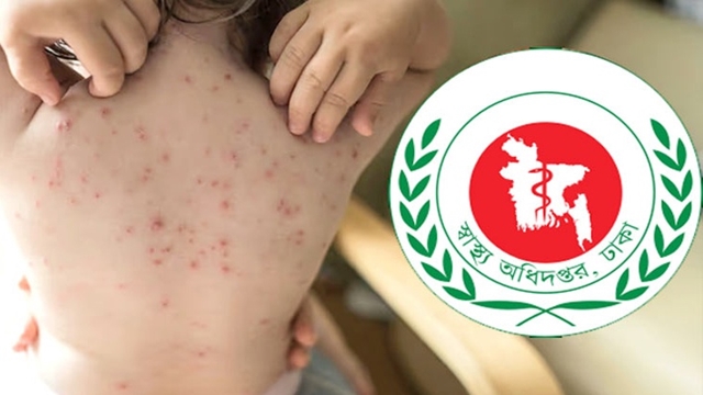 দেশে হাম ও উপসর্গে আরও ১২ জনের মৃত্যু; দুই মাসে প্রাণহানি ৪৫১